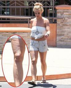 大腿抽脂的明星,揭秘明星大腿抽脂术后的蜕变之路